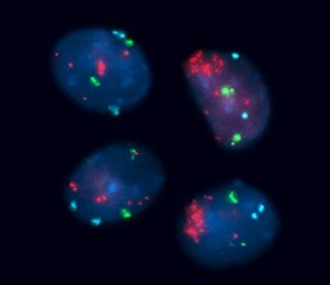 An image showing the increased copy number of the telomerase gene in cancer
