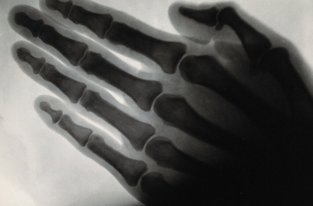X-rays