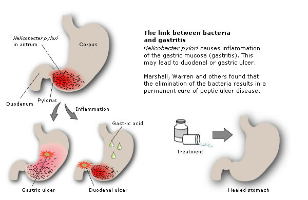 The link between bacteria and gastritis