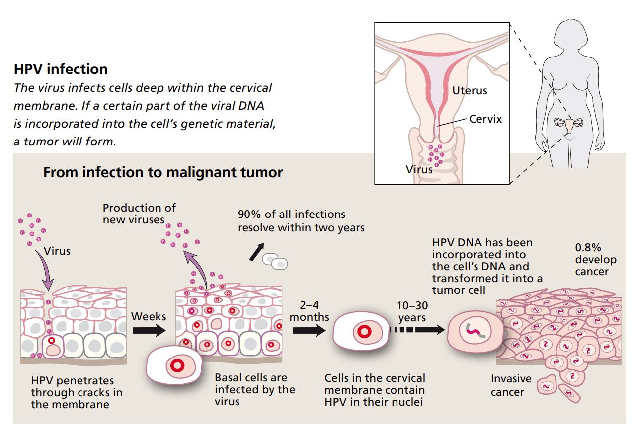 From infection to malignant tumor